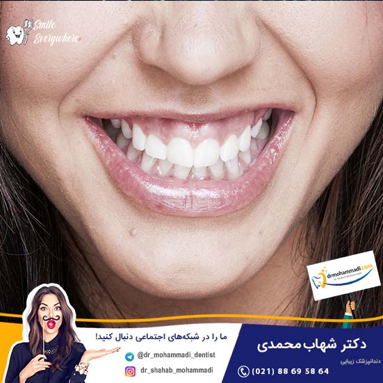 اصلاح طرح لبخند لثه ای چیست؟ - کلینیک دندانپزشکی دکتر شهاب محمدی